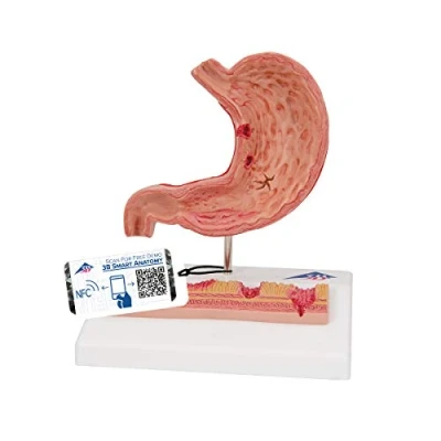 Obrázek 3B Scientific Lidská anatomie žaludek se žaludečními vředy + bezplatná aplikace pro Smart Anatomy