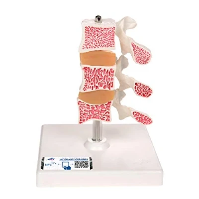 Obrázek 3B Scientific lidská anatomie Osteoporose 3 bederní páky, na stativ + bezplatný anatomický software Smart Anatomy