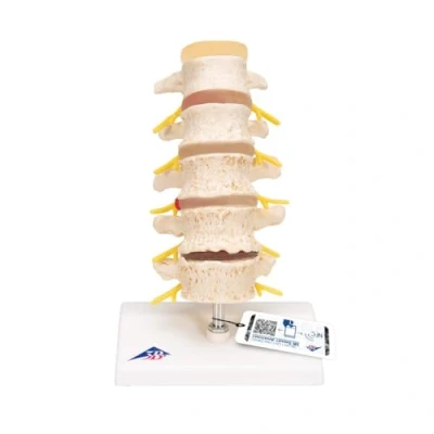 Obrázek 3B Scientific Lidská anatomie fáze herniovaného ploténky a degenerace obratlů + bezplatná aplikace pro anatomii Smart Anatomy, A795