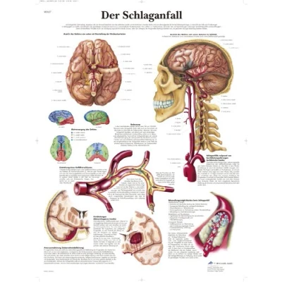 Obrázek 3B Scientific kalibr tabule Der Infarktu
