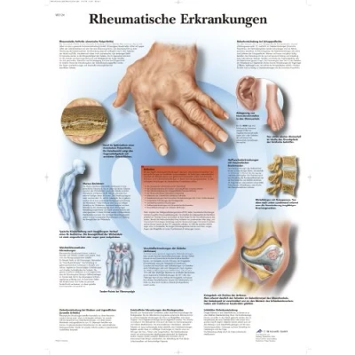 Obrázek 3B Scientific Tabule pro učitele revmatická onemocnění
