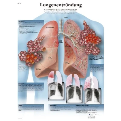 Obrázek 3B Scientific kalibr tabule Laminované Pneumonie
